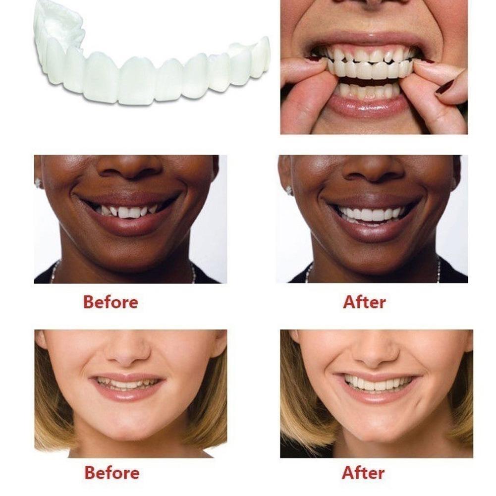 Perfect Smile Pro™ SnapOn Smile Veneers - 50% OFF - TrenLit